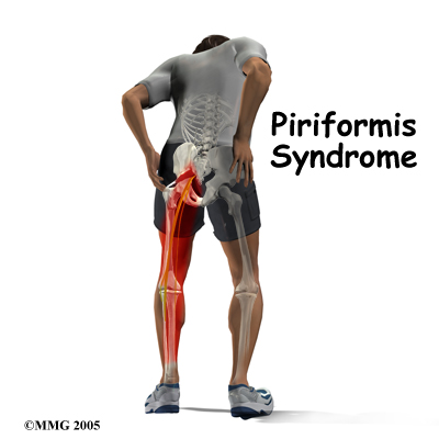 Piriformis sendromu makalesi
