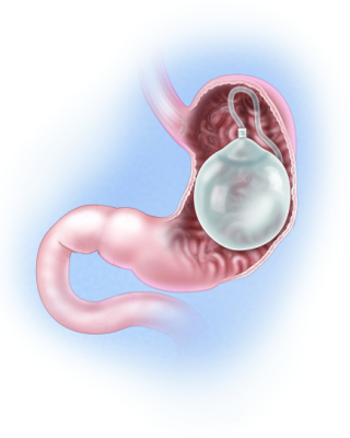 İntra gastrik balon nedir?
