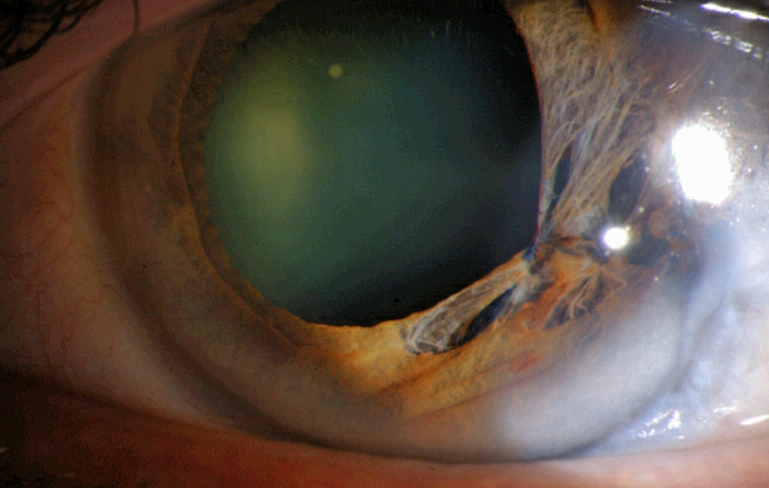 Puppıloplasty nedir?