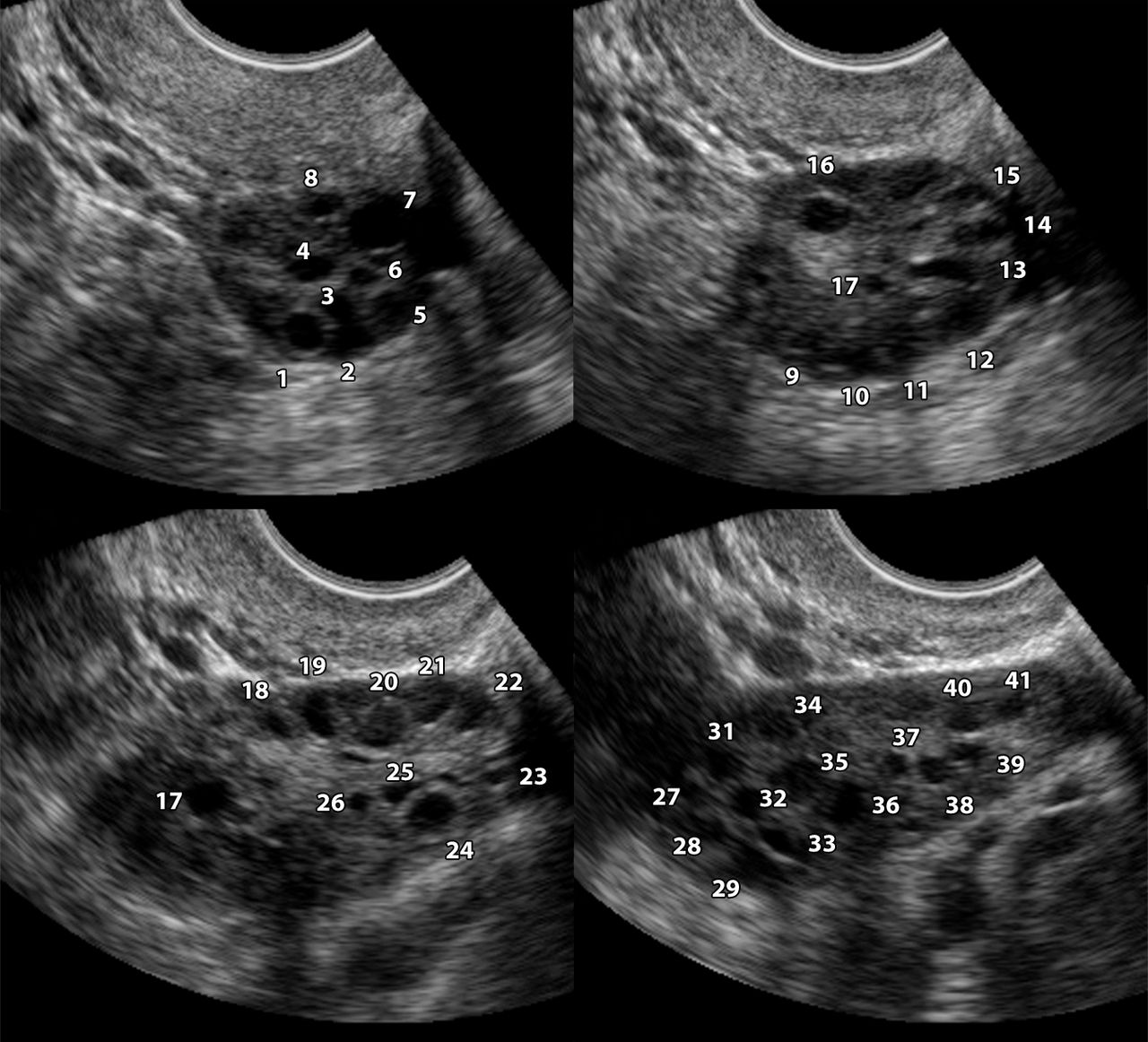 Polikistik over sendromu ( pcos)