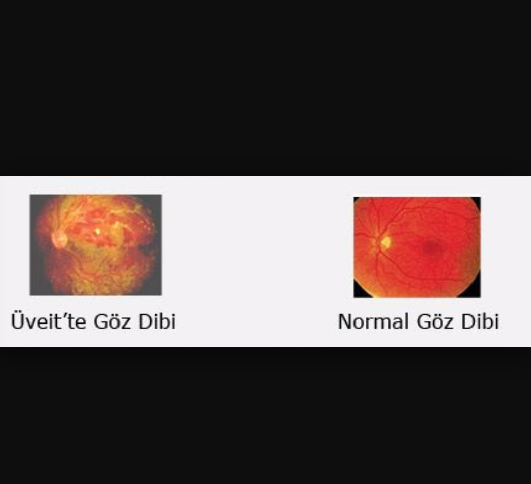 Üveit nedir? Tedavisi nasıldır?