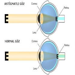 Astigmatizma