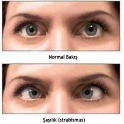 Şaşılık