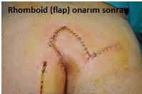 Pilonidal sinüs (kıl dönmesi) ve cerrahi tedavisi