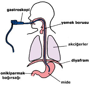 Gastroskopi