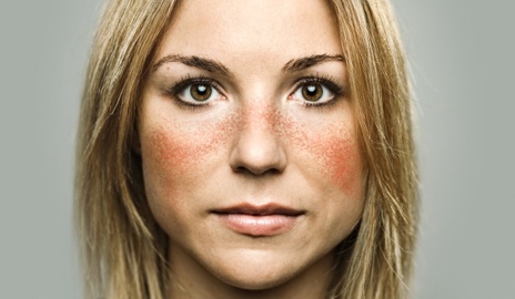 Lupus nedir?