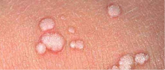 Genital siğil ve tedavi yontemleri
