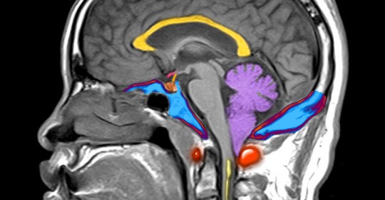 Chiari tip1 Malformasyonu