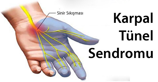 Karpal tünel sendromu (el bileği seviyesinde sinir sıkışması)