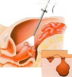 Rahim Ağzı (Serviks) Kanseri,