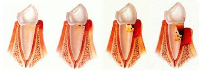 PERIODONTOLOJI makalesi