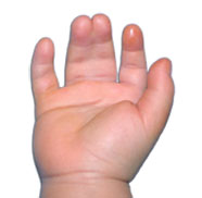 Yapışık parmak sendromu (Sindaktili)