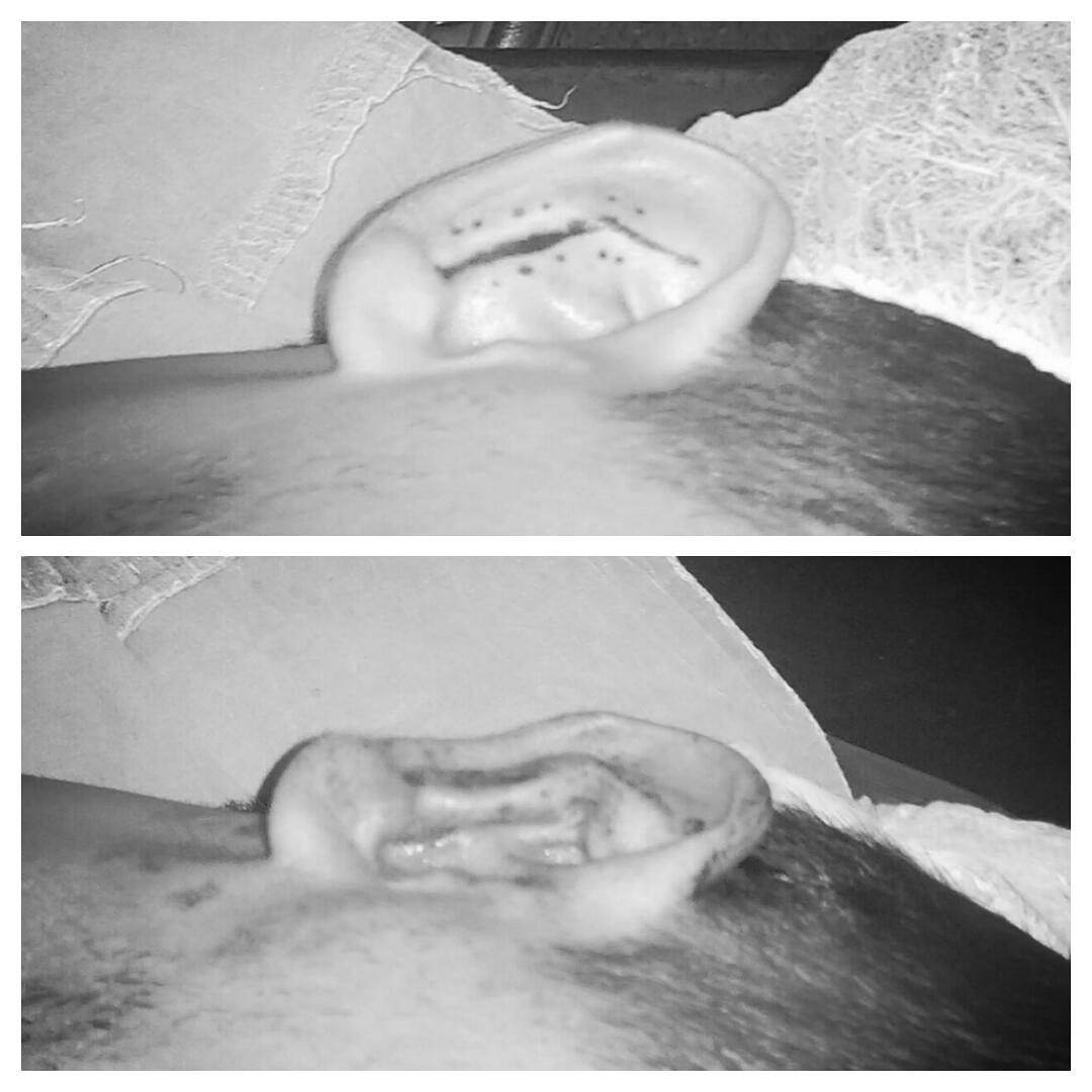Kepçe Kulak (Belirigin Kulak) Düzeltilmesi (Otoplasti)