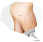 Estetik Yağ Alma Operasyonu | Liposuction