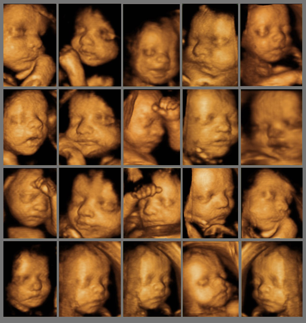 Ayrıntılı Ultrason (İleri Düzey Ultrason – Detaylı Ultrason) nedir? Neden yapılır?