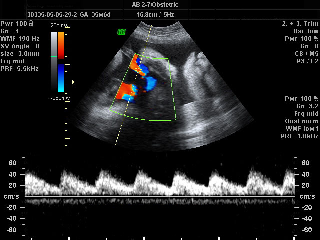 Doppler Ultrasonografi nedir?