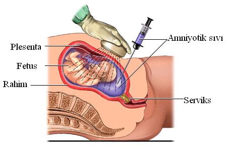 Amniyosentez (Amniosentez) nedir ? Neden yapılmalıdır?