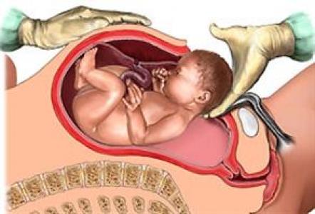 Sezeryan (Sezaryen)!!