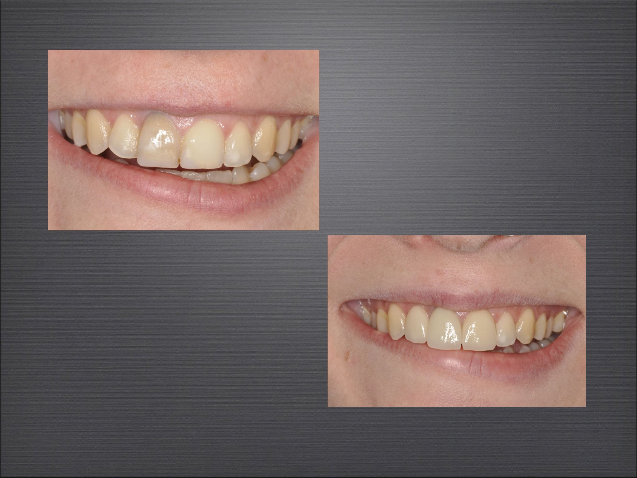 implant Uygulama Alanları