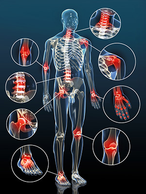 OSTEOARTRİT ( KİREÇLENME )