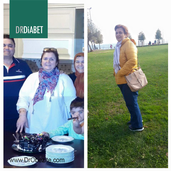 Morbid Obezite Nedir? Kimlere Morbid Obez Denir?