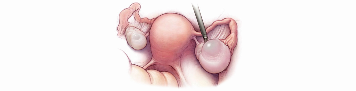 Yumurtalık kistleri!!