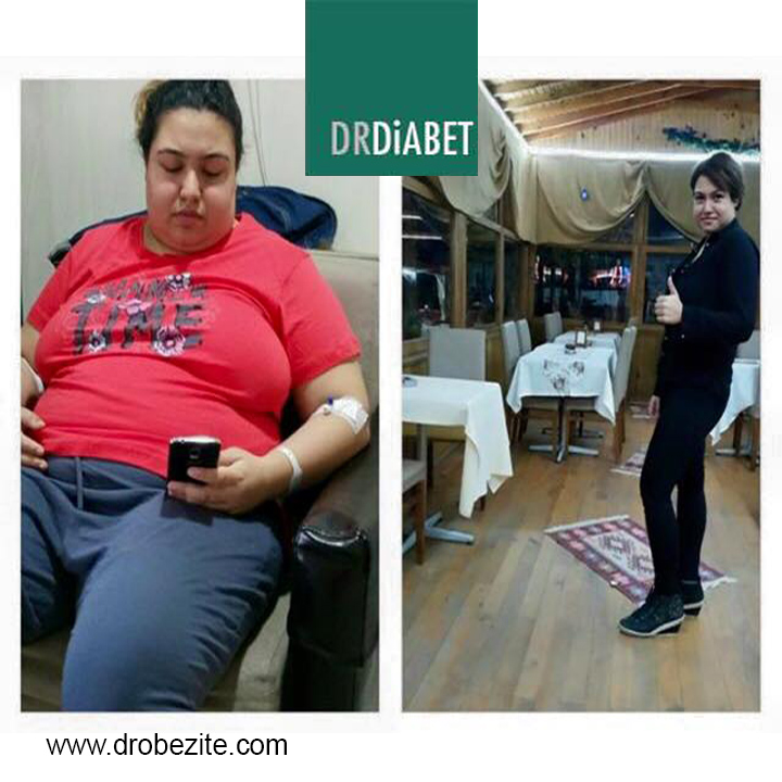Gastrik By-Pass Sonrası Püre-Katı Beslenme