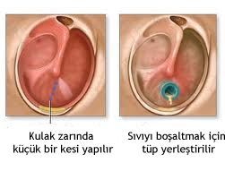 Kulak zarına tüp takılması