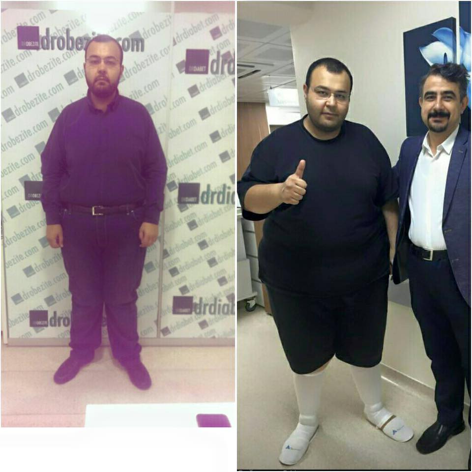 Bariatrik Cerrahi Sonrası Dumping Sendromu Ve Beslenme Önerileri