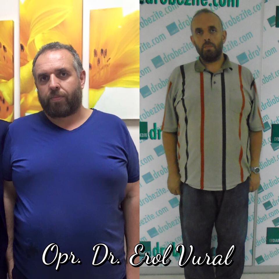 Obezite Cerrahisi Ve Karbonhidratların Seçimi