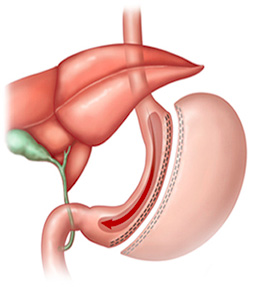 Tüp Mide Ameliyatı – Sleeve Gastrectomy
