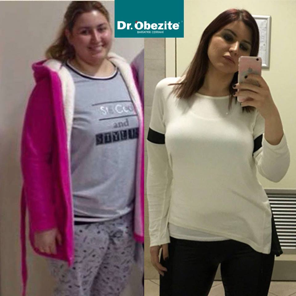 Obezite Ameliyatları Ve Sigara Alışkanlığı