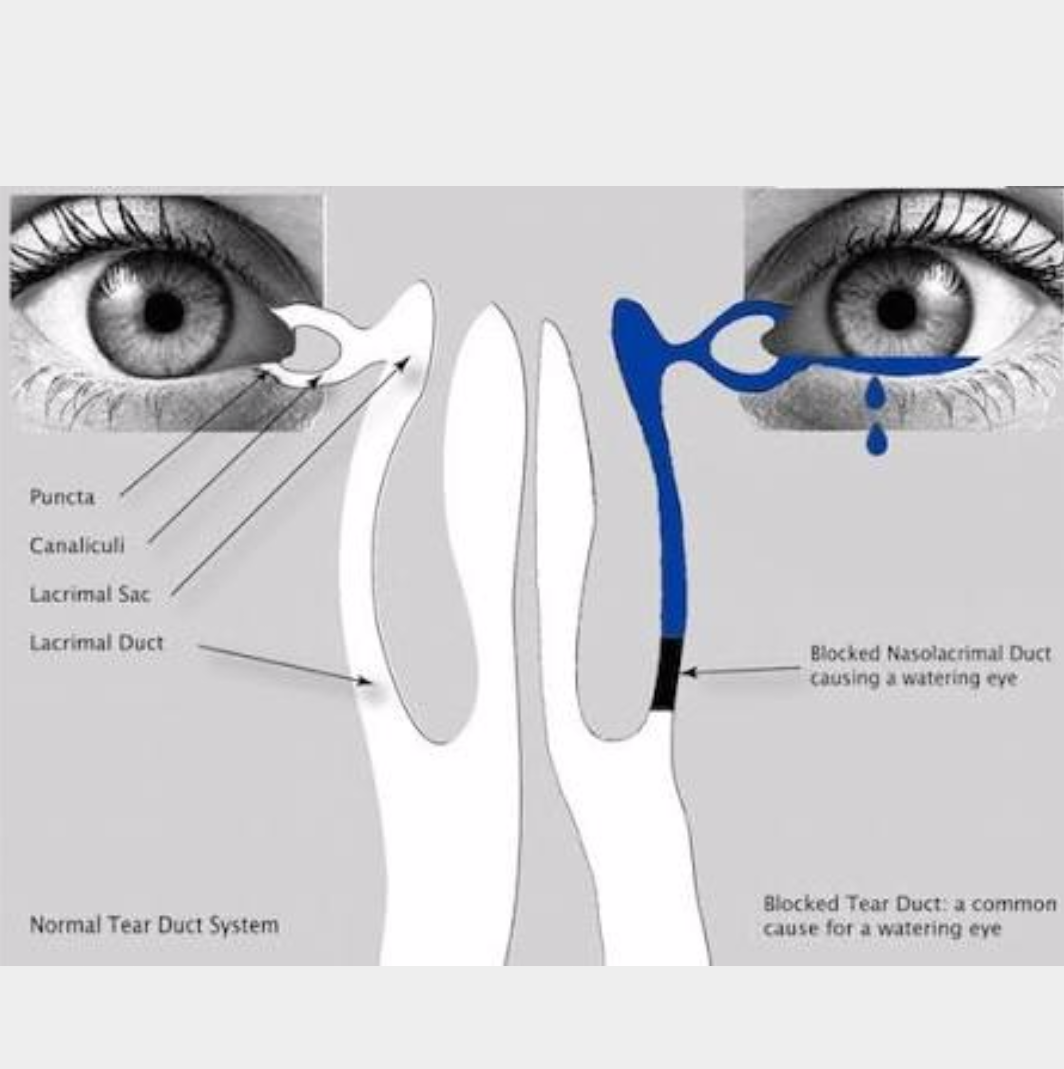 WHAT IS A BLOCKED TEAR DUCT ?