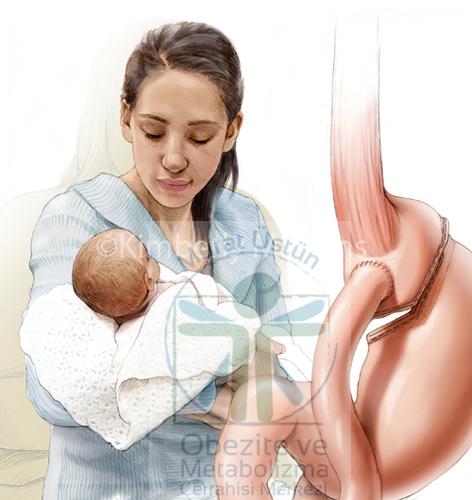 Obezite Cerrahisinden Sonra Gebelik ve Doğum Kontrolü