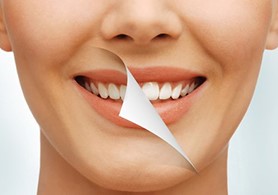 Gülüş Tasarımı Nedir? Nasıl Yapılır?