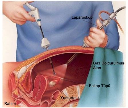 Laparoskopi Nedir? Laparoskopik Uygulamalar Nelerdir? makalesi