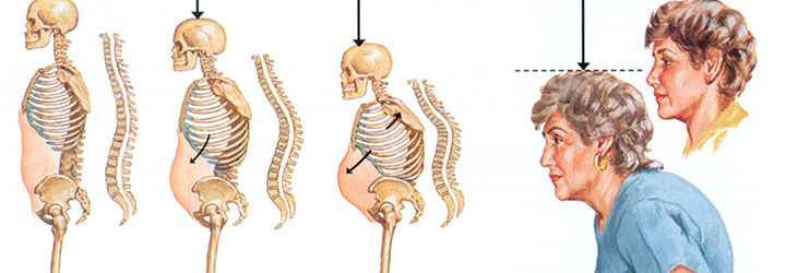 Osteoporoz ve Beslenme