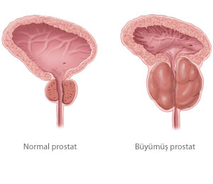 Prostat Biyopsisi Nedir? makalesi