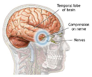 Prolaktinoma Hakkında (Hipofiz Tümörü)