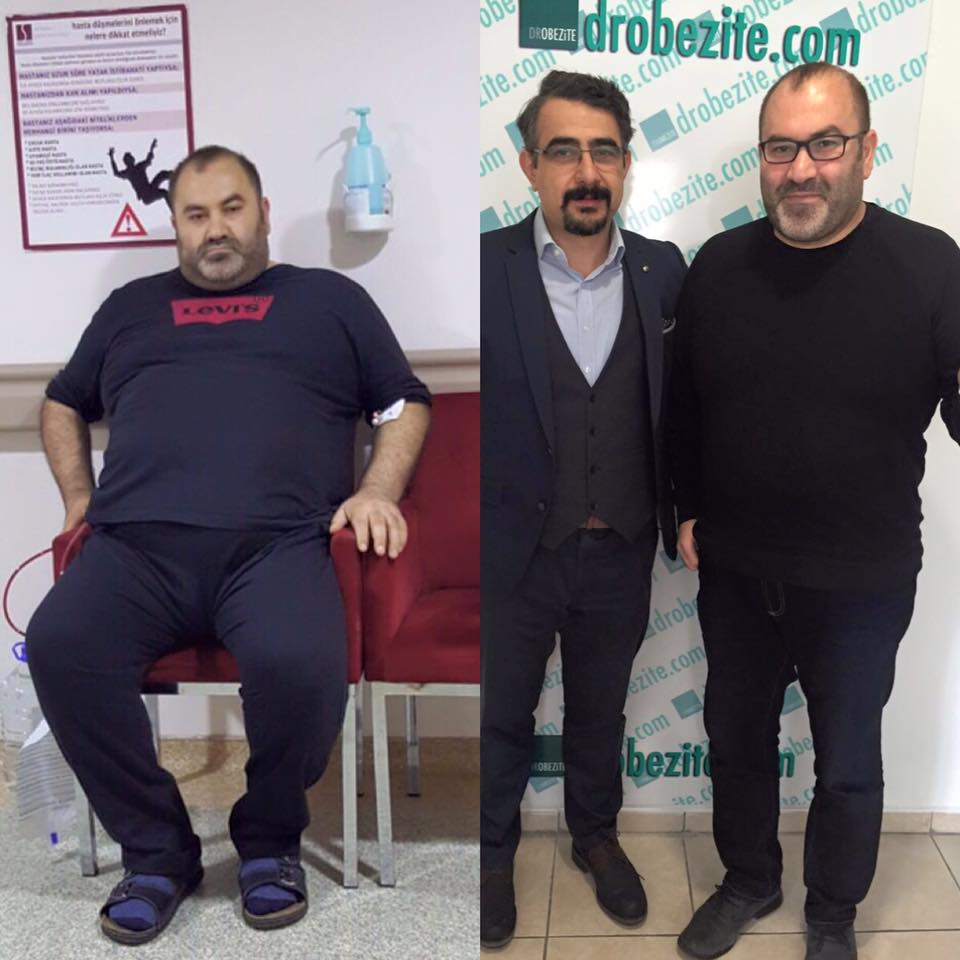 Tüp Mide Ameliyatı Nasıl Yapılır?