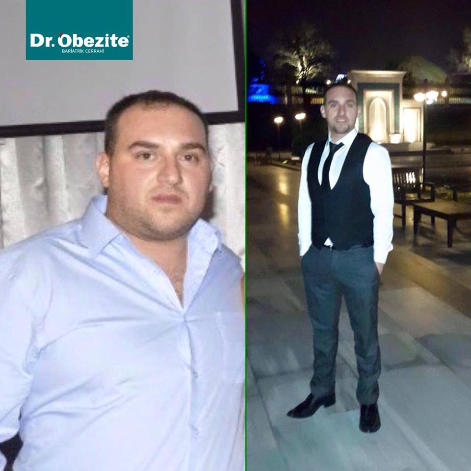Obezite Tedavisi Nasıl Yapılıyor?