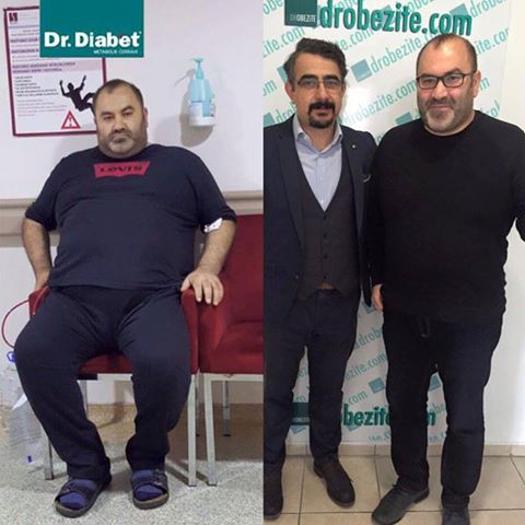 Obezite Cerrahisi ve Kaygı Bozukluğu