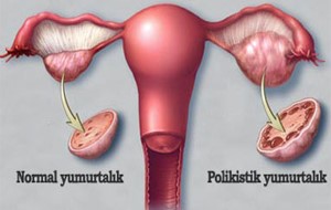 POLİKİSTİK OVER SENDROMU NEDİR?  (PCOS) makalesi