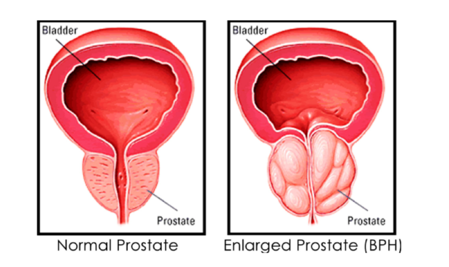 İYİ HUYLU PROSTAT BÜYÜMESİ (BPH)