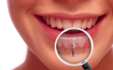 DENTAL (DİŞ ) İMPANTLAR NEDİR? makalesi