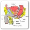 Prostatit nedir? Tedavi Yöntemleri nelerdir?