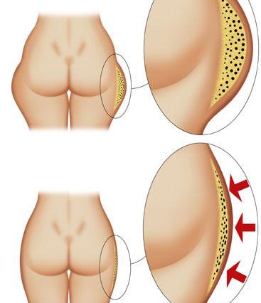 Lipoliz Nedir? Nasıl Uygulanır?
