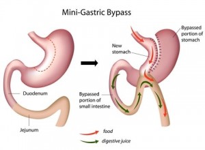 Mini Gastric Bypass Ameliyatı makalesi