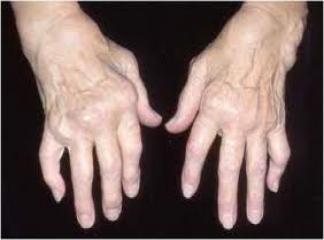 Romatoid Artrit ve Beslenme (Bağışıklığı güçlendiren yiyecekler)