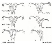 Rahim anomalileri Nasıl oluşur?